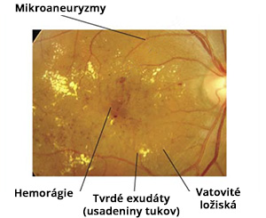 Znaky diabetickej retinopatie