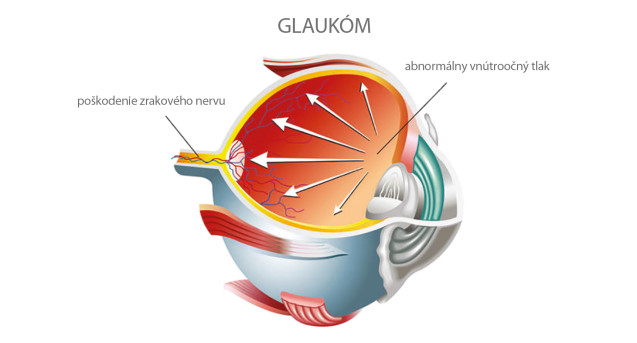 popis glaukomu
